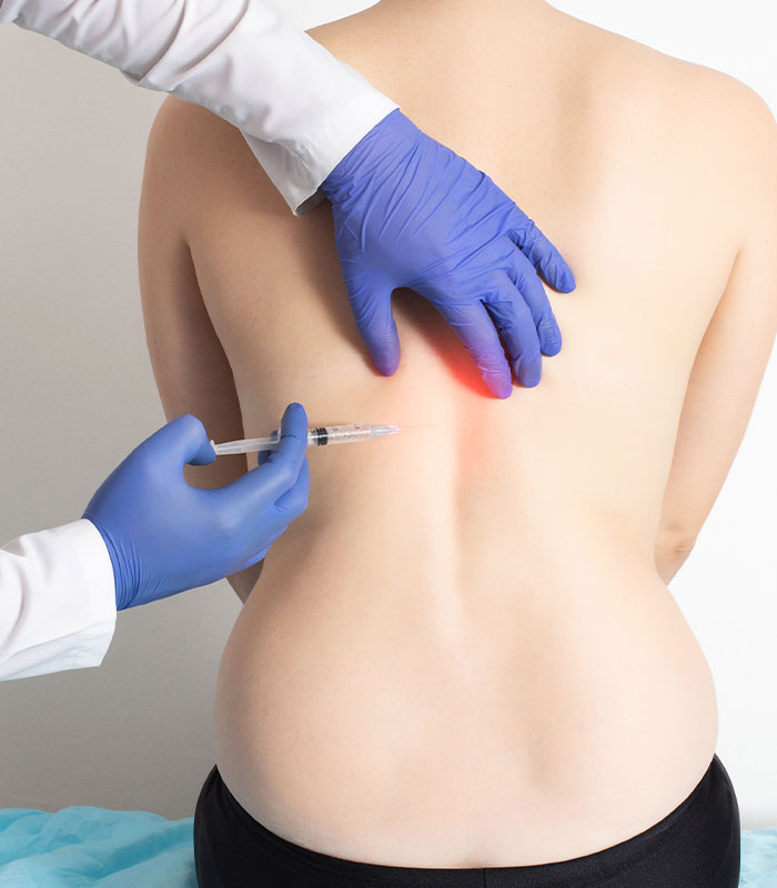 Trigger Point Injections